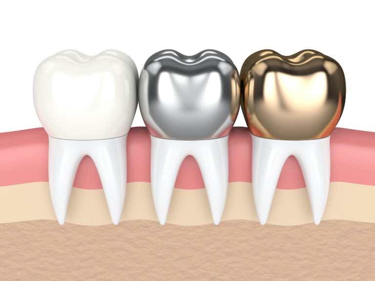 Ceramic Crowns Your Caring Sunshine Coast Dentist Hinterland View